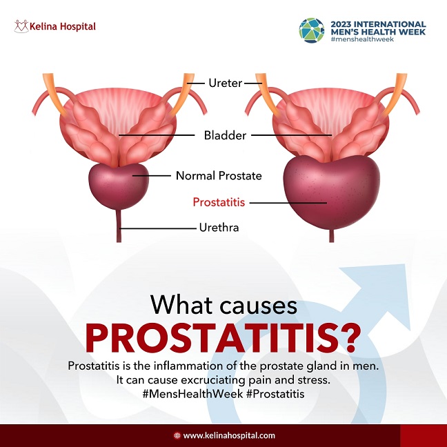Kaj povzroča kronični prostatitis?