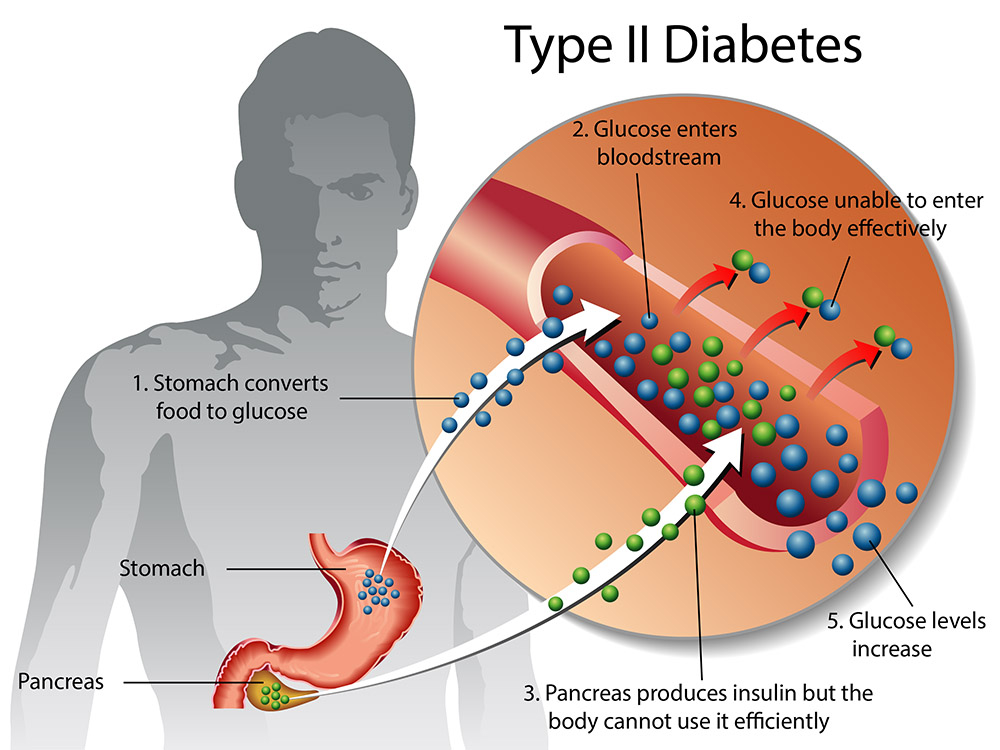 Kaj je sladkorna bolezen tipa 2?