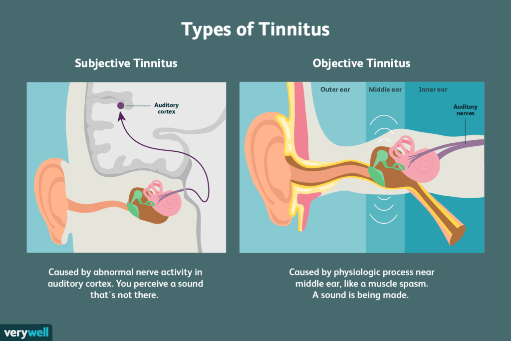 Înțelegerea tinitusului